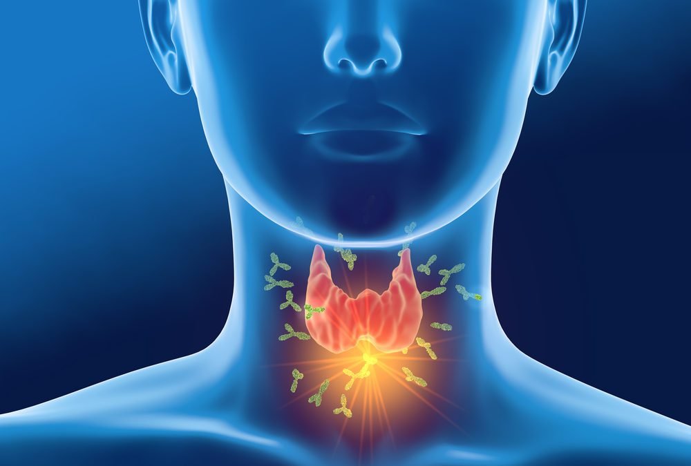 How to Fix High Thyroid Antibodies