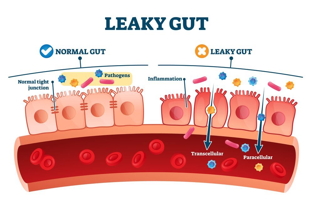 How To Heal A Leaky Gut Naturally